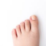 Onicocriptose (Unhas Encravadas)