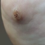 Verruga Plantar