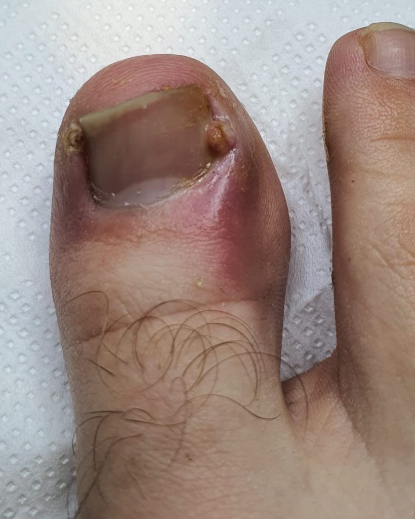 Onicocriptose (Unha encravada)